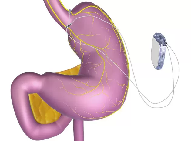 Approvato il “Pacemaker per il controllo dell’appetito”